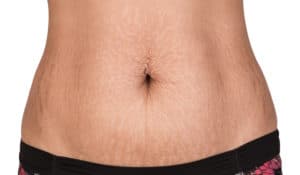 Stretch Marks Removal Williamsville, NY