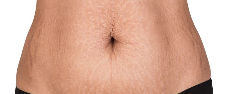 Stretch Marks Removal Williamsville, NY