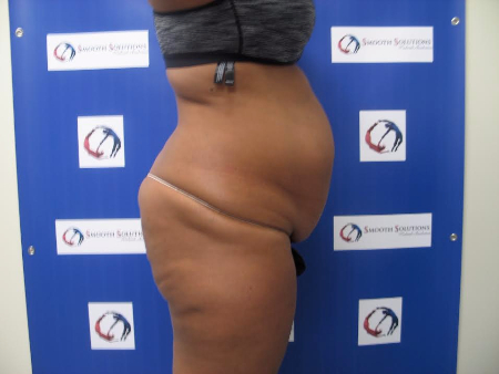 Before Image: Patient # 14331 - 