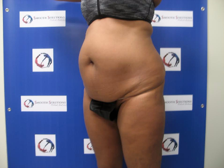 Before Image: Patient # 14331 - 