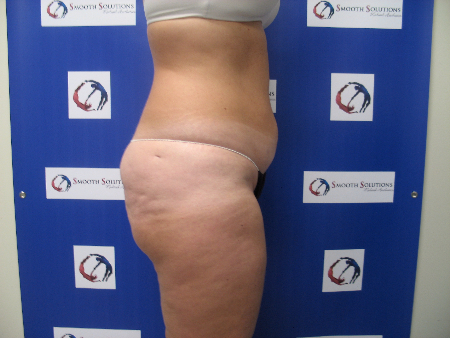 Before Image: Patient # 52345 - 