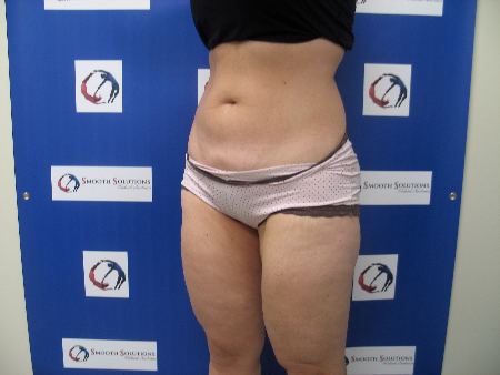 After Image: Patient # 52345 - 