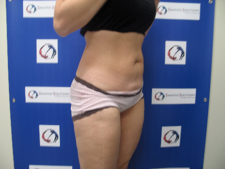 Before Image: Patient # 52345 - 
