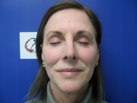 After Image: Patient # 71058 - 