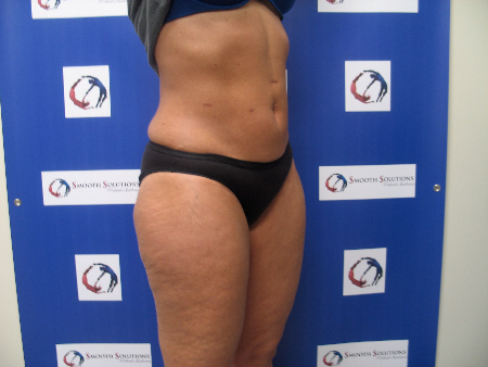 After Image: Patient # 15499 - 