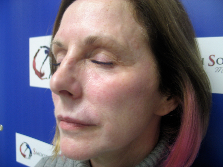 Before Image: Patient # 71058 - 