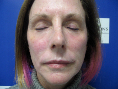 Before Image: Patient # 71058 - 