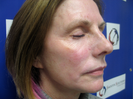 After Image: Patient # 71058 - 
