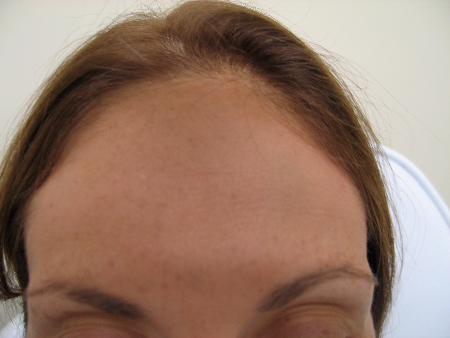 After Image: Patient # 49242 - 
