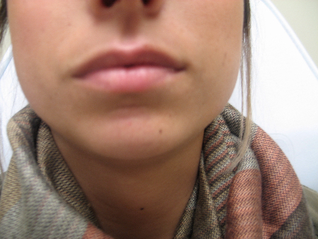 Before Image: Patient # 24713 - 