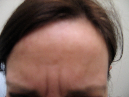Before Image: Patient # 12625 - 