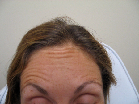 Before Image: Patient # 49242 - 