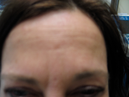 After Image: Patient # 12625 - 