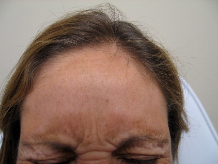 Before Image: Patient # 49242 - 