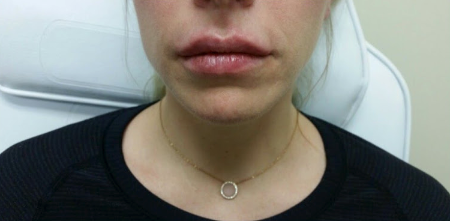 After Image: Patient # 53198 - 