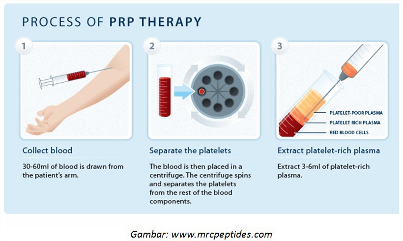 Intra Articular Joint Injection PRP