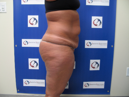 Before Image: Patient # 81249 - 