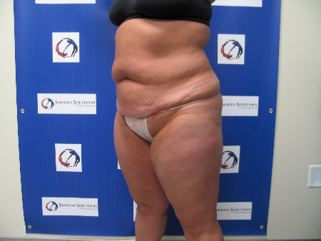 Before Image: Patient # 81249 - 