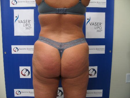 After Image: Patient # 81249 - 