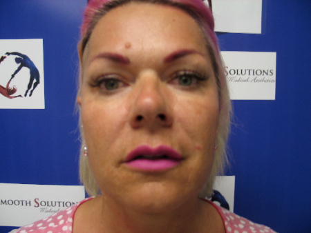 After Image: Patient # 33679 - 