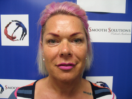 Before Image: Patient # 33679 - 