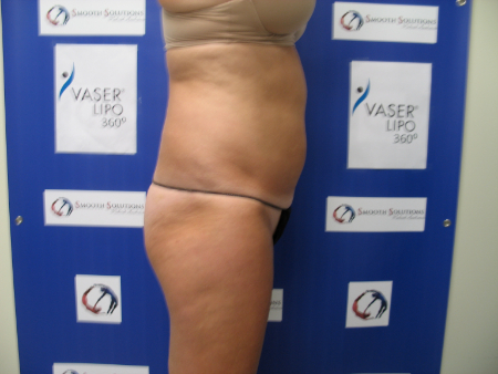 Before Image: Patient # 43842 - 