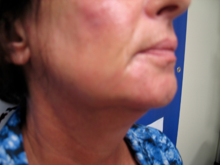 After Image: Patient # 66780 - 
