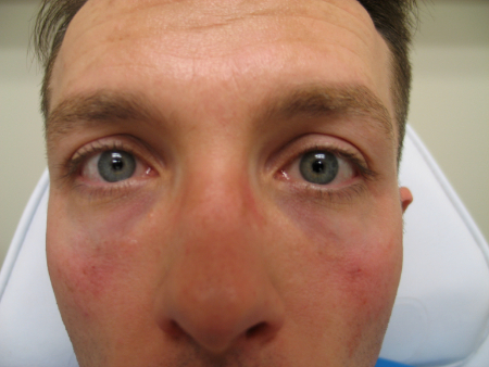 After Image: Patient # 53464 - 