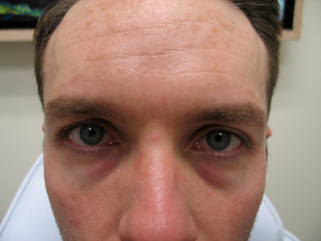 Before Image: Patient # 53464 - 
