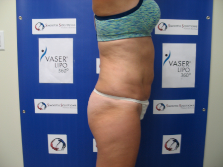 After Image: Patient # 43842 - 