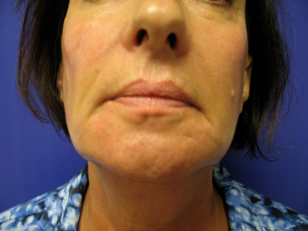 After Image: Patient # 66780 - 