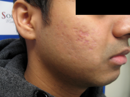 Before Image: Patient # 81461 - 