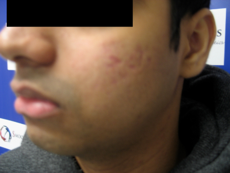 Before Image: Patient # 81461 - 