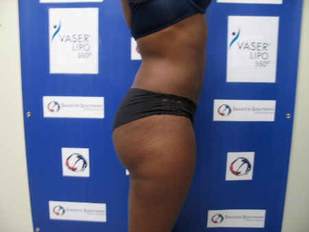 After Image: Patient # 29296 - 