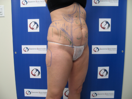 Before Image: Patient # 50542 - 