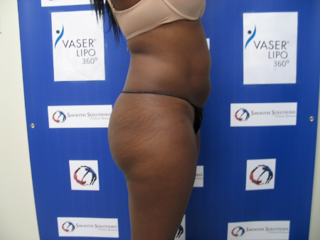 Before Image: Patient # 29296 - 