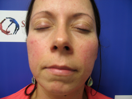 Before Image: Patient # 50052 - 