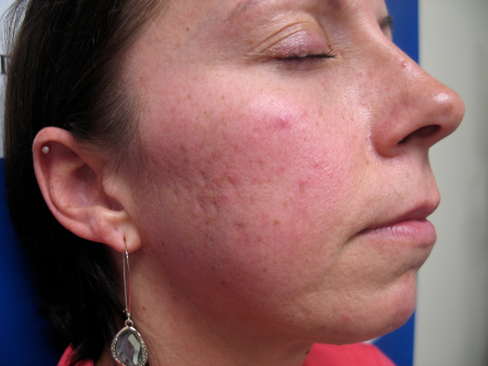 Before Image: Patient # 50052 - 