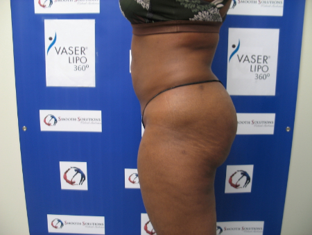 After Image: Patient # 92117 - 