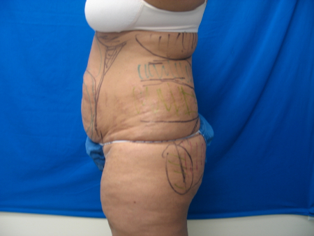 Before Image: Patient # 79480 - 