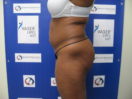 Before Image: Patient # 92117 - 