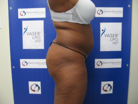 Before Image: Patient # 92117 - 