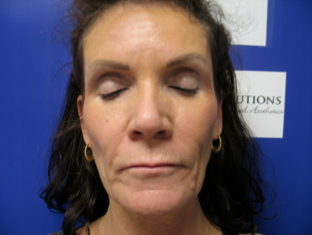Before Image: Patient # 27223 - 