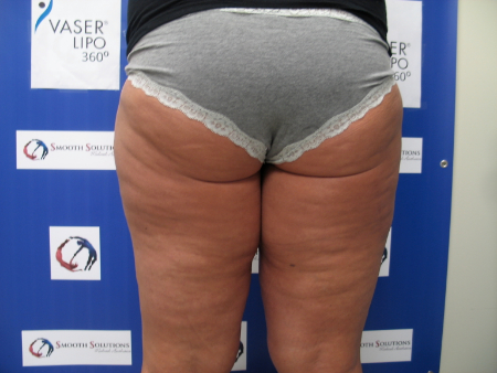 Before Image: Patient # 23663 - 