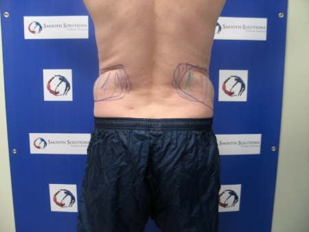 Before Image: Patient # 44831 - 
