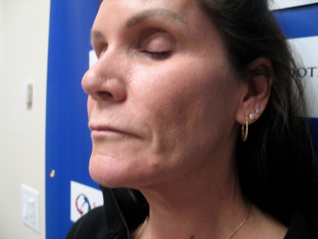 After Image: Patient # 27223 - 