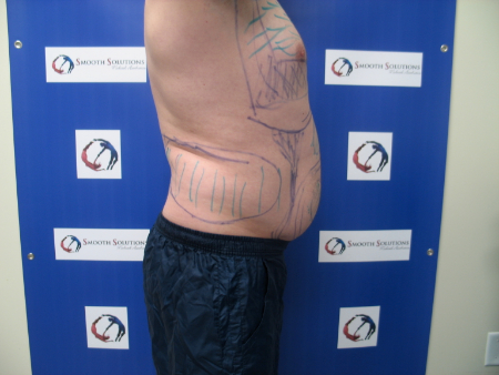 Before Image: Patient # 44831 - 