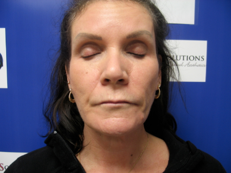 After Image: Patient # 27223 - 