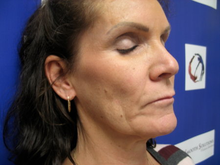 Before Image: Patient # 27223 - 