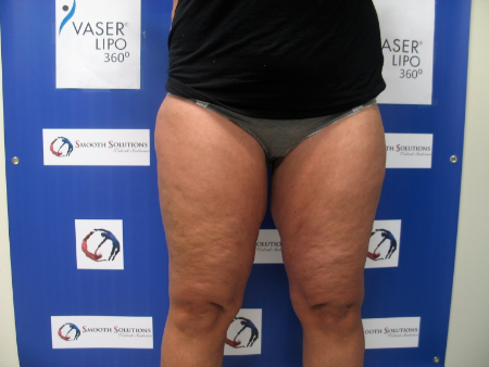 Before Image: Patient # 23663 - 